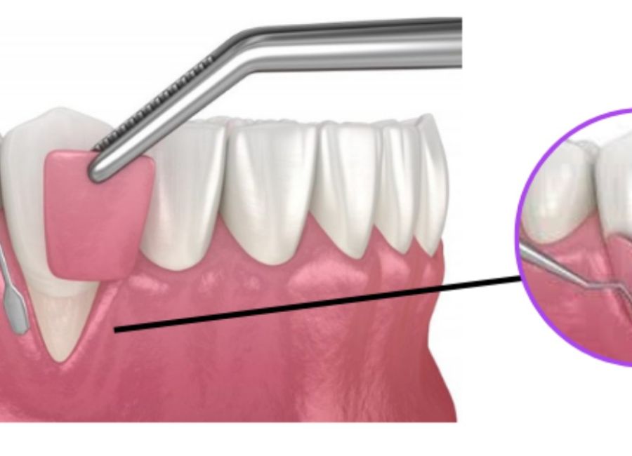 Diş Eti Grefti Ameliyatı