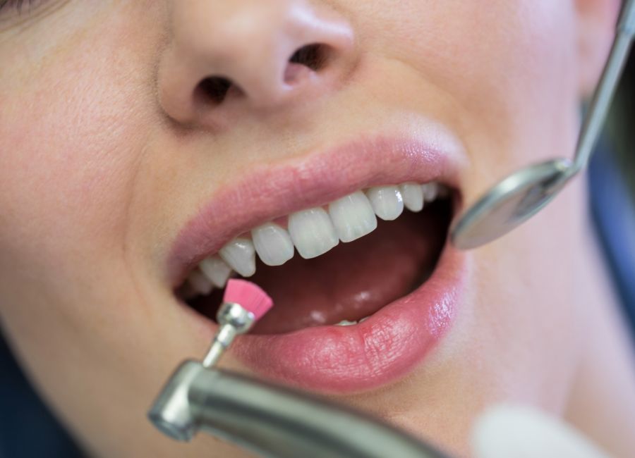 Diştaşı Temizliği