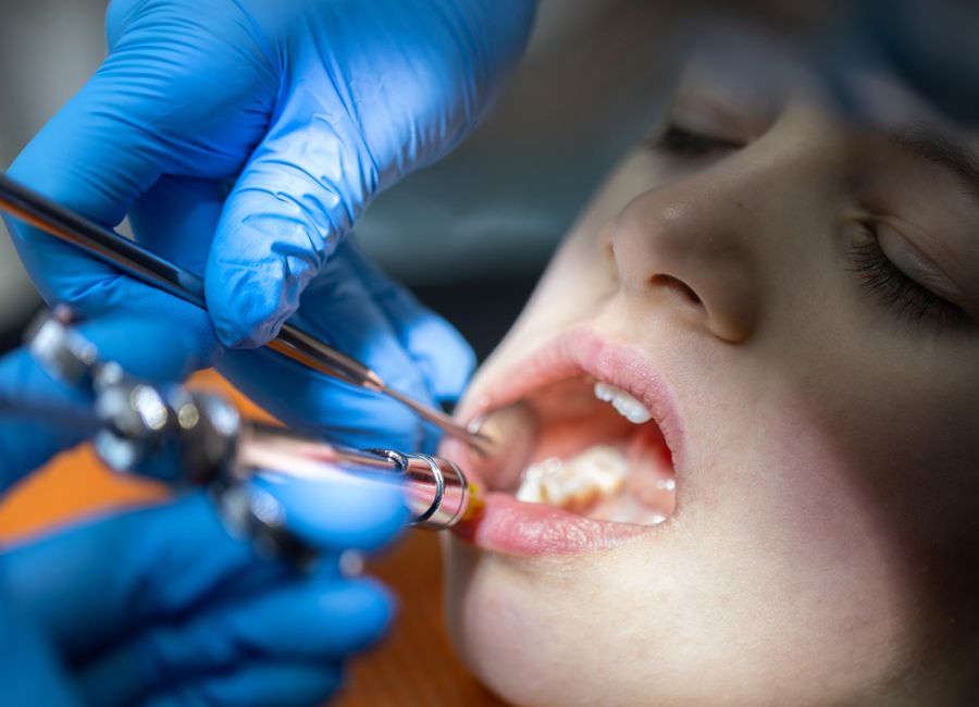 Süt Dişi Dolgu Tedavisi