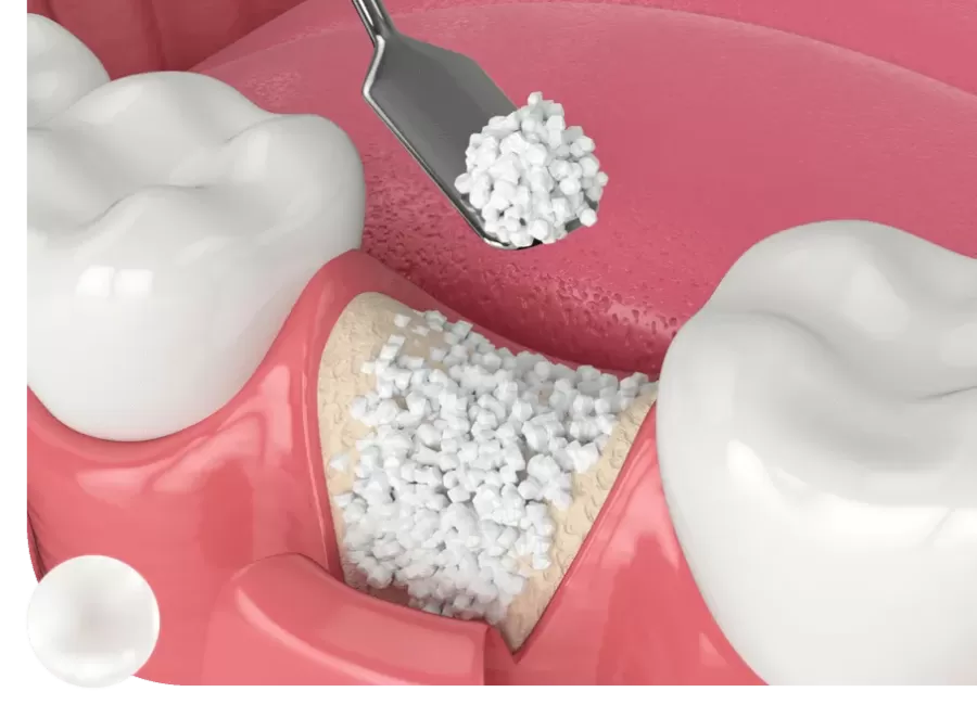 Kemik Grefti Ameliyatı