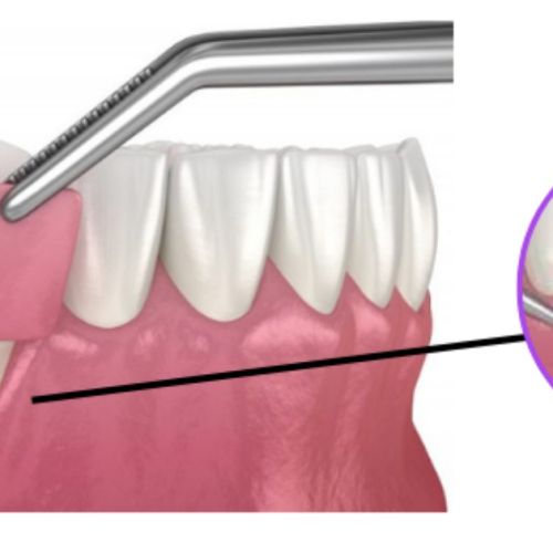 Diş Eti Grefti Ameliyatı