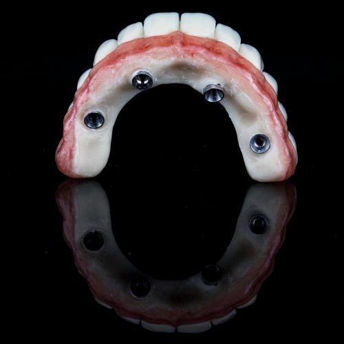 İmplant Üstü Protezler