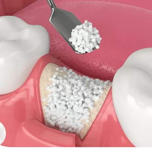 Kemik Grefti Ameliyatı